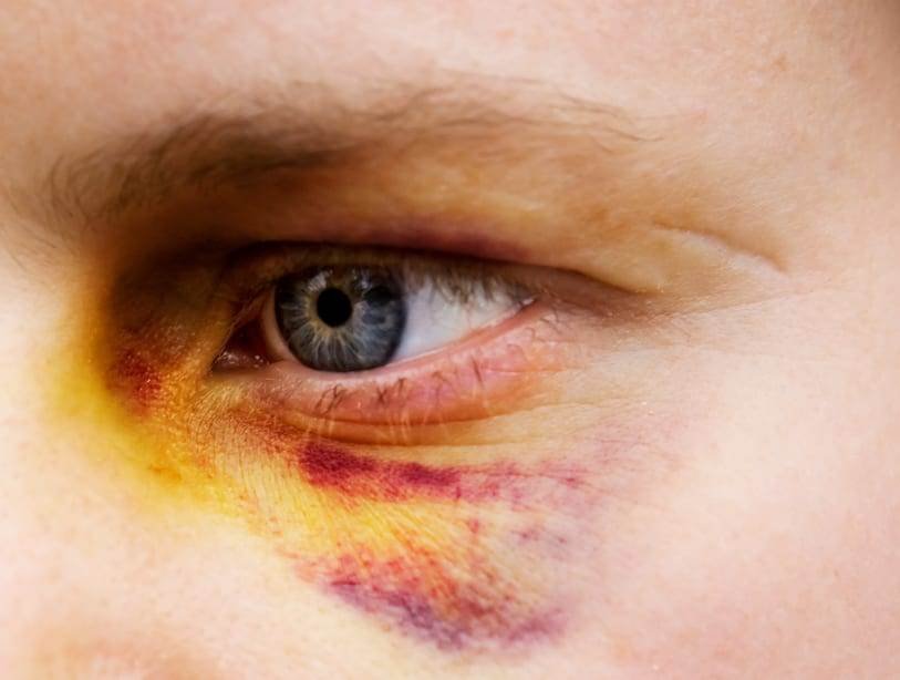 Close-up of a bruised eye, a common injury in assault offences.